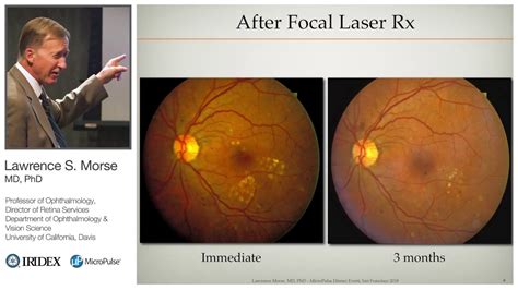 Overcoming the Challenges of Diabetic Macular Edema Laser Surgery: How a Low Vision Optometrist Can Help
